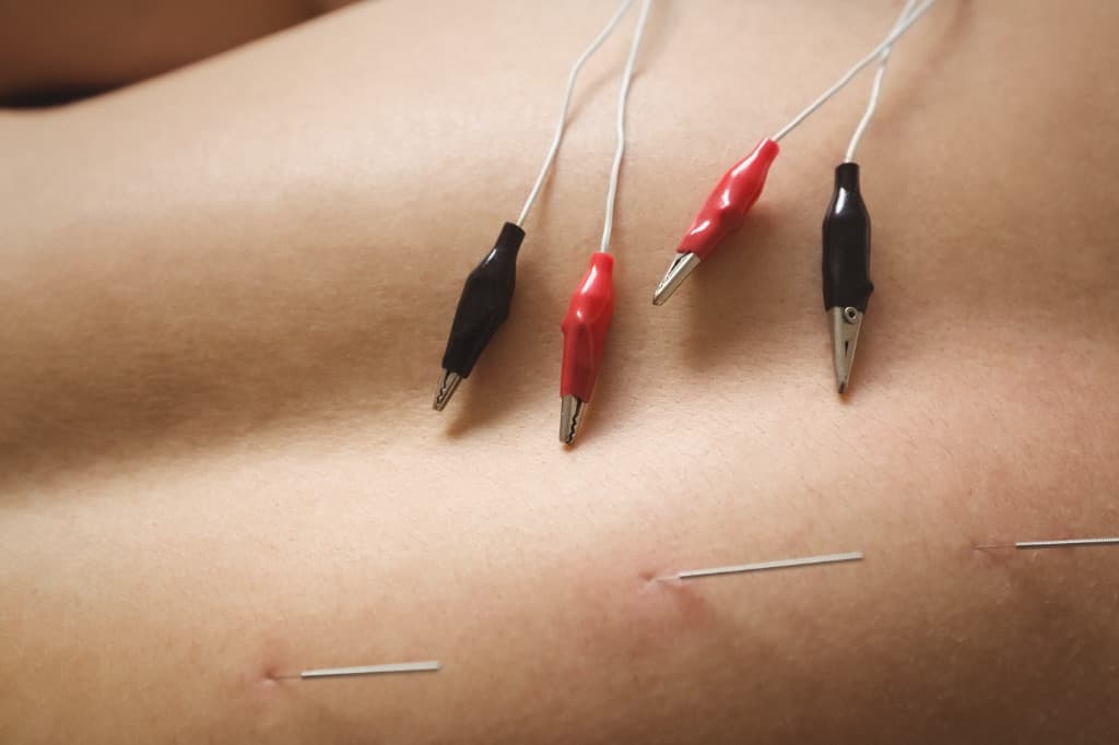 Acupuncture and Dry Needling